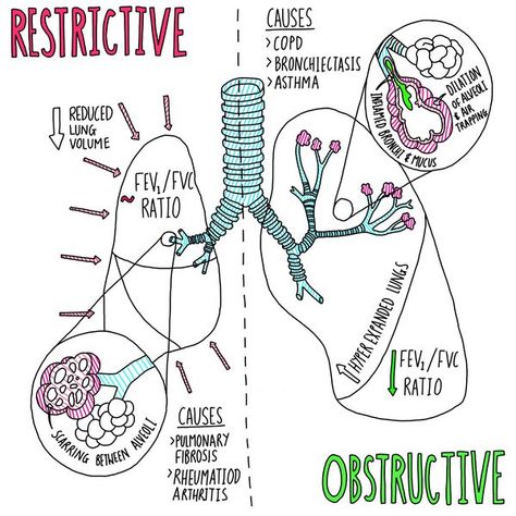 Image result for restrictive vs obstructive lung diseases Lungs Notes, Respiratory Therapy Notes, Respiratory Therapist Student, Respiratory Therapy Student, Medical Student Study, Pulmonology, Respiratory Care, Nursing School Survival, Respiratory Therapy