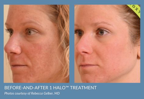 Halo™ Laser Skin Resurfacing vs. BBL: 3 Big Differences You Need to Know About | Med Spa in Torrance, CA | South Bay Plastic Surgeons Halo Laser, Face Procedures, Laser Skin Rejuvenation, Halo Glow, Laser Skin Resurfacing, Fractional Laser, Intense Pulsed Light, Skin Resurfacing, Laser Skin