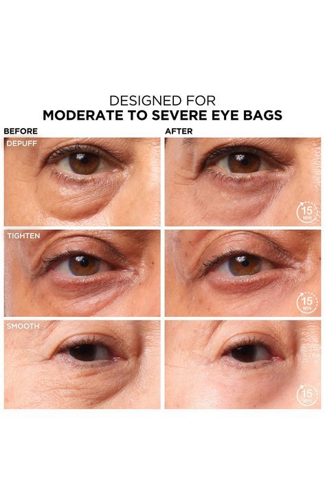 Eye Bag Filler, Makeup Eye Bags, Concealer For Eye Bags, Puffy Under Eyes Bags, Under Eye Bags Remedies, Under Eye Wrinkles Remedies Diy, Bags Under Eyes Remedy, Conceal Under Eye Bags, Eye Depuffing