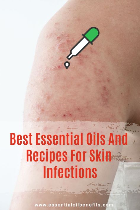 Essential Oils For Antibiotics, Oils For Infection On Skin, Essential Oils For Infection, Essential Oils For Rashes Skin, Antibacterial Essential Oils For Skin, Essential Oil For Excema, Essential Oils For Bacterial Infection, Essential Oil Recipes For Skin, Essential Oils For Itching Skin