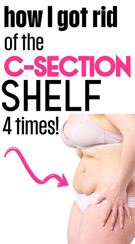 A new mom trying to lose her c-section shelf postpartum tummy with these postpartum workout tips. Shelf Workout, C Section Pouch, Postpartum Belly Workout, C Section Belly, After C Section Workout, Post C Section, C Section Workout, Belly Workouts, Pooch Workout