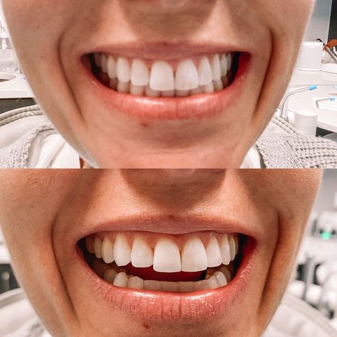 Invisalign Before And After, Smile Direct, Dental Center, Adams Family, Dental Insurance, Long Locks, After Photos, Insurance, I Am Awesome