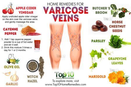 (1) New Messages! Varicose Vein Remedy, Top 10 Home Remedies, Venous Insufficiency, Holistic Remedies, Natural Therapy, Natural Home Remedies, Cayenne, Health Remedies, The Skin