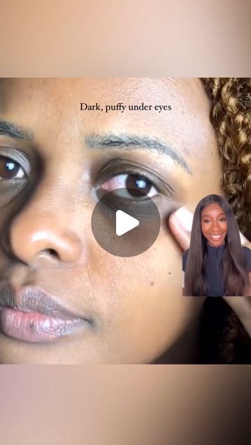 Dr Kemi Fabusiwa on Instagram: "👋 Puffy, dark circles? We’re ghosting those bad vibes 

Here’s what you need to do:

☀️Wear SPF around your eyes daily. This will protect your eyes from hyperpigmentation and sagging. 

💧Retinoid & Hyaluronic Acid: Your secret weapons! Apply these around your eyes to smooth fine lines and plump up that under-eye area. 💉

☕️ Caffeine: Perk up those eye bag with a caffeine boost.

🤧Antihistamines: Fight allergies and resist the urge to rub! 👀

#darkpuffyundereyes" Under Eye Puffiness, Bad Vibes, Beautiful Inside And Out, Eye Bags, Eye Area, Dark Circles, Hyaluronic Acid, Your Eyes, Allergies