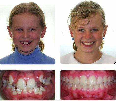 Teeth After Braces, Before And After Braces, Braces Before And After, Snow Teeth Whitening, After Braces, Zoom Teeth Whitening, Teeth Whitening Dentist, Activated Charcoal Teeth Whitening, Best Teeth Whitening Kit