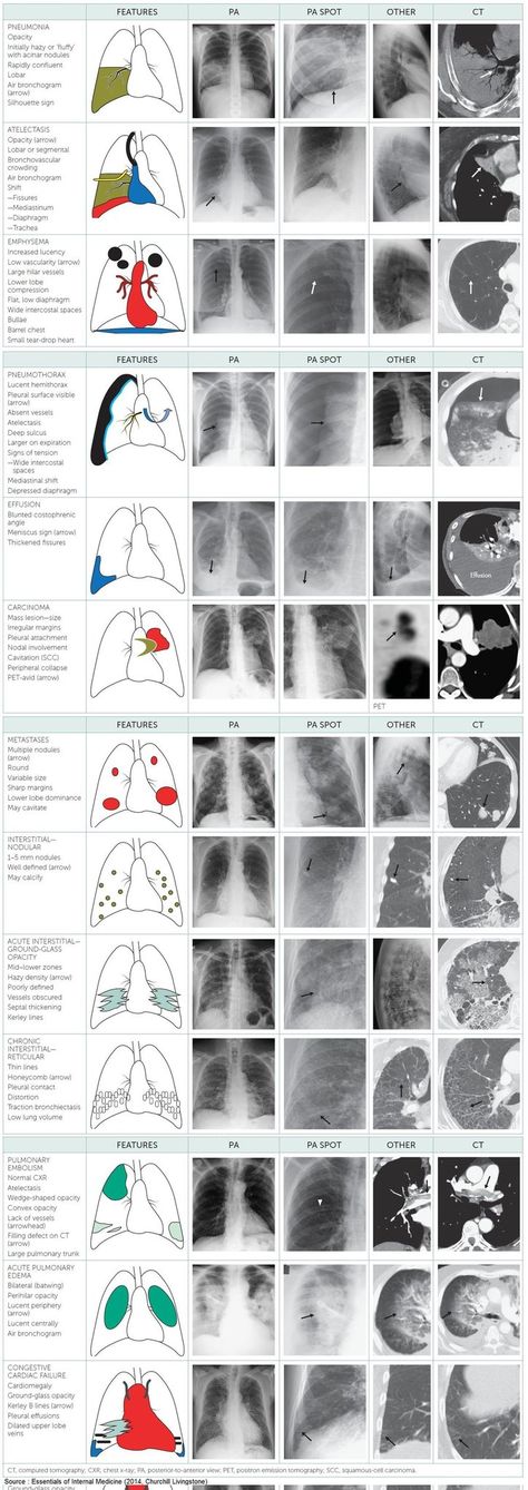 (1) Hans Huitink (@AirwayMxAcademy) / Twitter Chest Xray, Radiology Student, Radiology Imaging, Nursing School Essential, Medical School Life, Nursing School Motivation, Basic Anatomy And Physiology, Nurse Study Notes, Nursing Student Tips