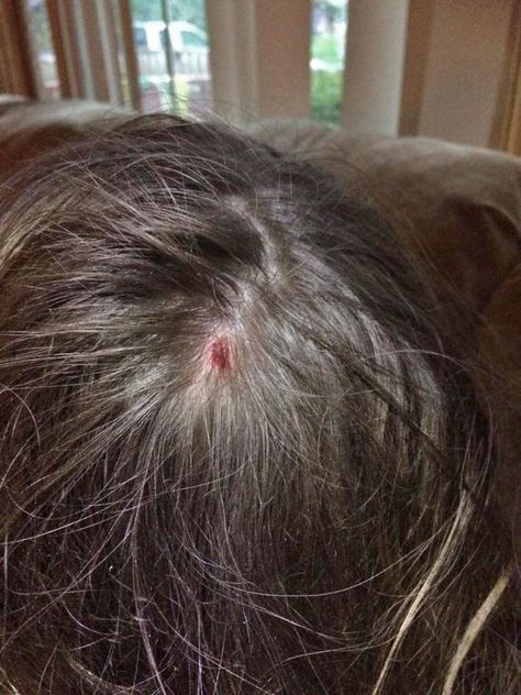 Tick bites cause baffling diseases in two girls in Nebraska #Tularmia #RockyMountainSpottedFever #NotJustLyme #LymeDiseaseChallenge Tick Bite, Happy Birthday Quotes Funny, Birthday Quotes Funny, Bacterial Infection, Before Bed, Happy Birthday Quotes, Two Girls, Rocky Mountain, Ticks