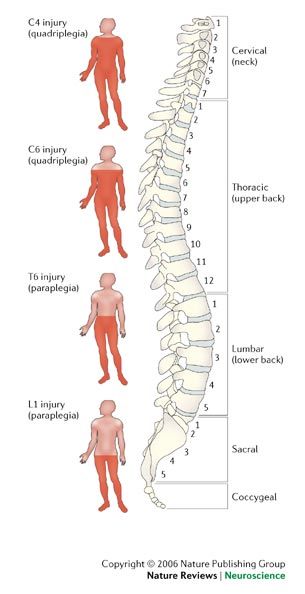 Wk 9: Spinal Cord Injury, Burn Injury, Septic Shock - Medical Surgical Nursing 211sp09 Nursing Neuro, Neuro Nursing, Nerdy Nurse, Septic Shock, Burn Injury, Med Surg Nursing, Physical Therapy Assistant, Nurse Study Notes, Nurse Inspiration