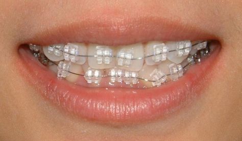 Porcelain Braces, Invisible Teeth Braces, White Braces, Braces Ideas, Zoom Teeth Whitening, Ceramic Braces, Braces Cost, Teeth Whitening Dentist, Activated Charcoal Teeth Whitening