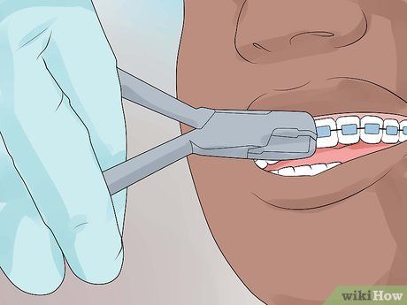 After Braces Tips, Retainers For Teeth, Retainers After Braces, Braces Removal, Braces Hacks, Before And After Braces, Teeth After Braces, Invisible Teeth Braces, Braces Care