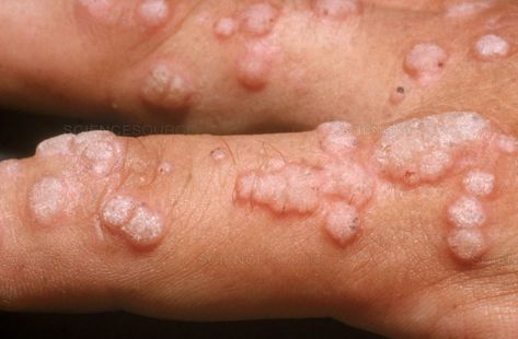 Verruca Vulgaris Wart Cream, Human Pictures, Stop It, Health Tips, Disease, Health And Beauty, Conditioner, Medical, Human