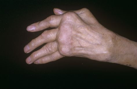 If you have pain in four or more joints, you may have polyarthritis. Learn the most common causes and what it means for your health. Healthy Lifestyle Motivation Quotes, Arthritic Hands, Cushings Syndrome, Signs Of Inflammation, Body Inflammation, Sjogrens Syndrome, Inflammation Causes, Autoimmune Disorder, Chronic Inflammation