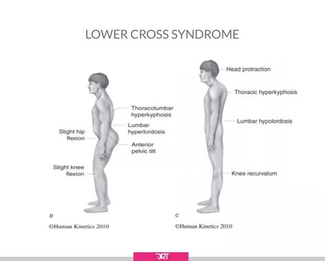 Lower Cross Syndrome In Dressage Riders - Upper Cross Syndrome Exercises, Lower Cross Syndrome, Upper Cross Syndrome, Lumbar Lordosis, Single Leg Bridge, Pelvic Tilt, Tight Hips, Hip Flexor, Abdominal Muscles