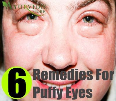 Swollen Eyelids Remedy, Swollen Eye Remedies, Swollen Eyelid, Puffy Eyes Remedy, Allergy Eyes, Baggy Eyes, Swollen Eyes, Under Eye Puffiness, Dark Circles Under Eyes