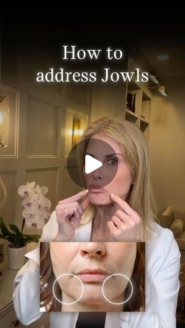 Jill Campbell - Houston Nurse Practitioner on Instagram: "▪️Botox does not remove excess loose skin or fat in the jowels.  ▪️Botox keeps the DAO and platysmal bands from pulling down.  ▪️Botox also keeps the chin from pulling up.   ▪️Lessening the pull helps to better Defyne the jowels and jawline.   🛟 Save this post for your reference.  👩🏼‍⚕️ Jill Campbell , FNP-C, CANS 📍 The Woodlands, TX 💻 @aestheticsjill • 🏥 Dr.Guy Facial Plastic Surgery ☎️ (832) 956-1040  💻  @drguyfacialplastics • 🏥 Avante Laser & Medical Spa ☎️ (281) 419-0080 💻 @avantemedispa  #filler #botox #houston_insta #houstoninjections #houstonfiller #thewoodlandstx #jillcampbellaesthetic #facialbalance #facialsymmetry #dysport #daxxify #wrinklefree #wrinkles #nomorewrinkles #Jawlinefiller #chinfiller #cheekfiller #fac Natural Fillers For Face, Buckle Fat Removal, Botox Placement, Jawline Fillers Before And After, Chin Fillers Before After, Platysmal Bands, Body Plastic Surgery, Chin Filler, Cheek Fillers