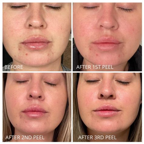 Skin Care Routine By Andrea Acne Peel, Forehead Acne, Acne Dark Spots, Natural Acne Remedies, Congested Skin, Healthier Skin, Hormonal Acne, Skin Redness, Acne Blemishes