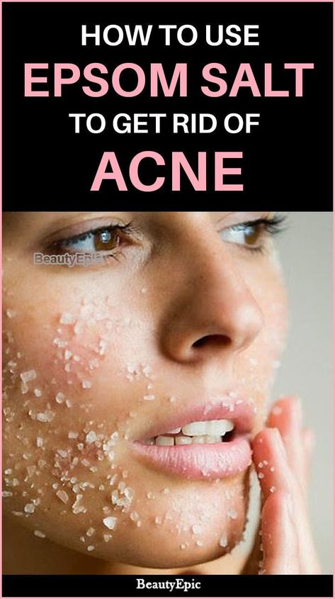 How to Use Epsom Salt To Get Rid Of Acne Get Rid Of Acne Fast, Forehead Acne, Epson Salt, Get Rid Of Acne, Rid Of Acne, Home Remedies For Acne, Baking Soda Shampoo, Health Trends, Acne Remedies