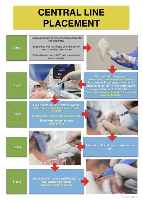 st mungo's-Central Line Central Line Placement, Central Line Catheter, Central Line Nursing, Picc Nurse, Iv Line, Central Line, Respiratory Therapy, Sketches Pencil, Med Surg