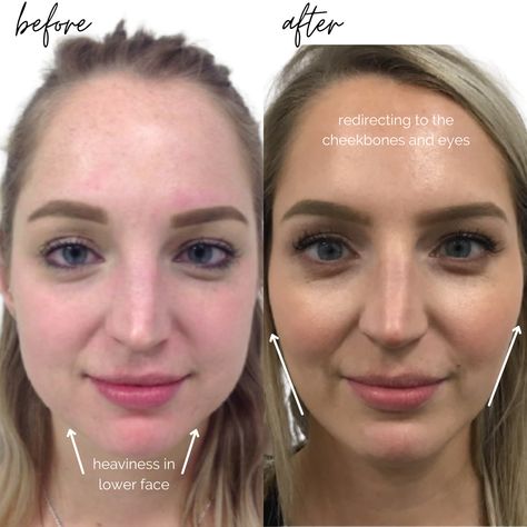 Facial Contouring Fillers, Facial Balancing, Jawline Contouring Filler, Face Contouring Fillers, Before And After Jaw Filler, Chin Jaw Cheek Filler, Before And After Cheek Filler, Facial Symmetry Filler, Facial Balancing Filler