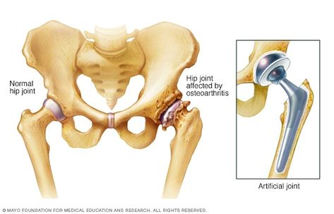 Hip Fracture, Leg Veins, Hip Surgery, Mayo Clinic, Alternative Medicine, Indore, The Help