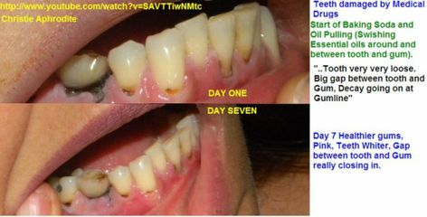 This is a follow up from my previous Oil Pulling updates found here: http://www.mytrueessence.net/1/post/2013/06/can-you-really-re-growremineralize-your-teeth-and-gums-my-oil-pulling-experiment-with-photo-evidence.html... Health Coconut Oil, Coconut Oil For Teeth, Coconut Oil For Dogs, Diy Beauty Treatments, Coconut Oil Pulling, Teeth Health, Receding Gums, Benefits Of Coconut Oil, Coconut Oil For Skin