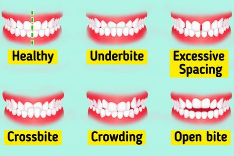 Different Types Of Teeth, Types Of Teeth, Tongue Thrust, Types Of Humans, Human Teeth, Front Teeth, 30 Day Workout Challenge, Wisdom Teeth, Improve Health