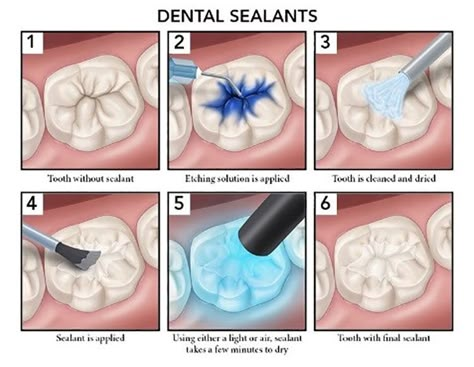 Dental Assistant Study Guide, Dental Notes, Dental Decor, Dental Assistant School, Dental Hygienist School, Dental Assistant Study, Dental Sealants, Dental Care For Kids, Dental Hygiene Student