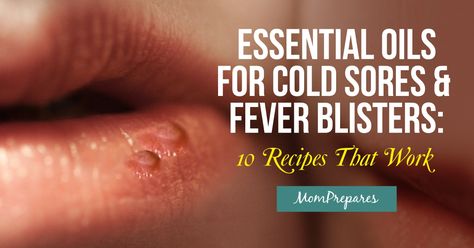 Essential Oil For Fever Blister On Lip, Essential Oils For Fever Blister, Fever Blister Essential Oils, Essential Oils For Blisters, Essential Oils For Cold Sores, Essential Oils For Fever, Fever Blister Remedy, Cold Sore Essential Oil, Essential Oils For Cold