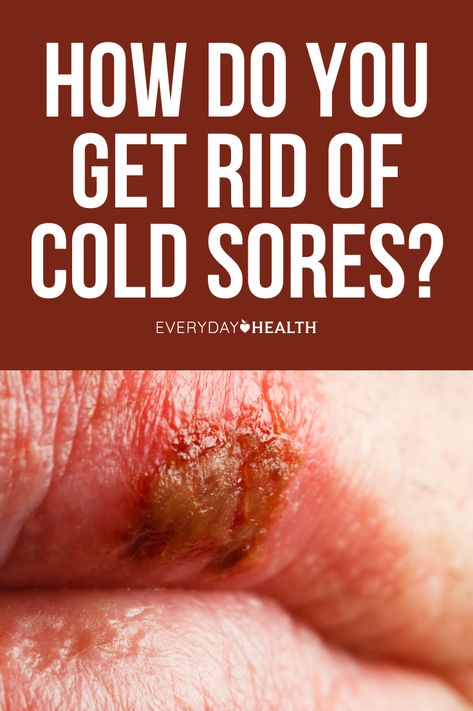 How Do You Get Rid of Cold Sores? What Causes Cold Sores? What Is a Cold Sore? Are Cold Sores Herpes? Are Cold Sores Contagious? What Does a Cold Sore Look Like? How Do You Prevent Cold Sores? What’s the Best Thing to Put on a Cold Sore? What Shouldn’t You Use on One? How Do You Cover Up a Cold Sore? How Common Are Cold Sores? Can You Pop a Cold Sore? Got questions about cold sores? Here’s a look at 10 frequently asked questions to help you recognize, treat, and avoid these blisters. How To Get Rid Of A Cold Sore Overnight, How To Prevent Cold Sores, Cold Sores Remedies Overnight, How To Get Rid Of Cold Sores, Cold Sore Remedy Overnight, Cold Sore Stages, Cold Sore Lip, Blister On Lip, Home Remedies For Cold