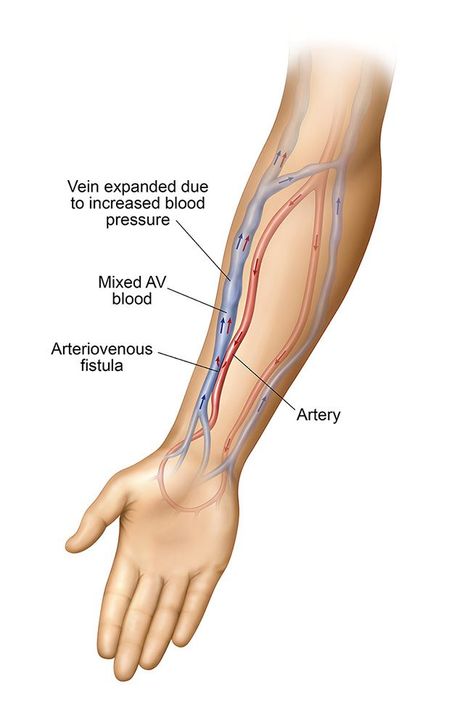 What Causes Stenosis in an AV Fistula and How Do I Recognize It? Clean Eating Smoothies, Medical Terminology Study, Vascular Ultrasound, Blood Sugar Tracker, Blood Sugar Solution, Vascular Surgery, Arteries And Veins, Summer Health, Medical School Essentials