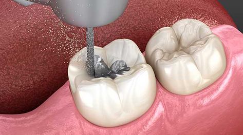 Cavity preparation of amalgam restoratios Prepared by : Maha Akram ￼ HISTORY ◦ •Amalgam was introduced to the United States in the1830s. ◦ •Initially, amalgam restorations were made by dentists filing silver coins and mixing the filings with mercury, creating a putty-like mass that was placed into the defective tooth. ◦ As knowledge increased and research intensified, major advancements in the formulation and use of amalgam occurred. ◦ • However, concerns about mercury toxicity we Zoom Whitening, Smart Method, Preventive Dentistry, Dental Fillings, Sedation Dentistry, Dental Emergency, Tooth Replacement, Restorative Dentistry, Emergency Dentist