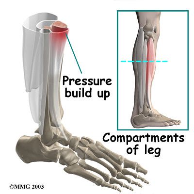 Shin Splints or Something More Serious? Anterior Shin Splints, Broken Fibula, Lower Leg Pain, Shin Splint Exercises, Magnetic Resonance Imaging, Musculoskeletal System, Shin Splints, Treadmill Workout, The Shins