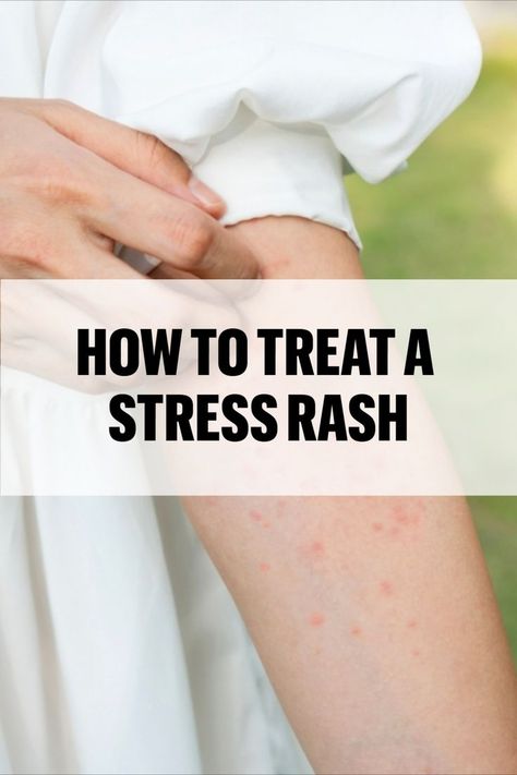 Stress Rash Home Remedies For Rashes, Body Rash, Rashes Remedies, Rash Causes, Home Remedies For Warts, Warts Remedy, Natural Remedies For Migraines, Itchy Rash, Sunburn Relief