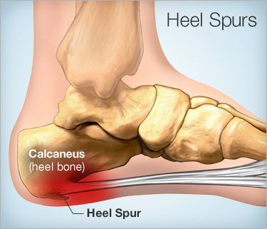 Heal Spurs, Heel Spur, Joints Pain Relief, Heel Pain, Foot Pain, Reflexology, Natural Home Remedies, Natural Treatments, Health Remedies