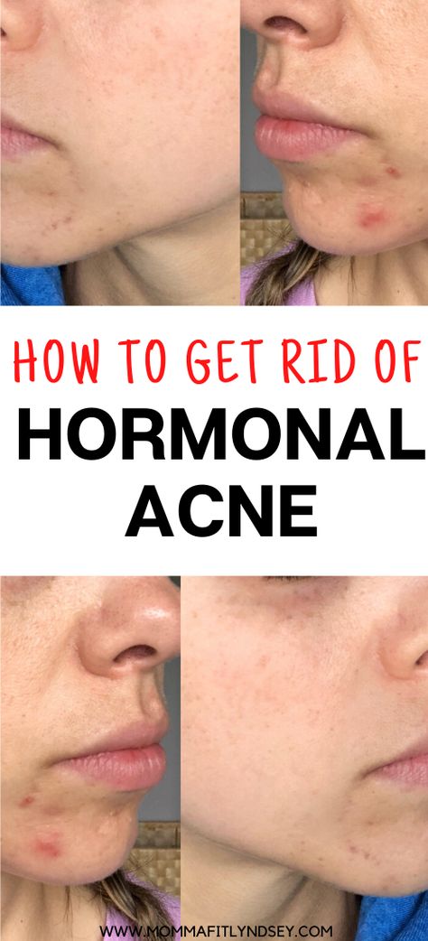 How to Get Rid of Hormonal Acne or Cystic Acne Naturally.  Get rid of chin acne with gut healing foods and natural products Acne Chin And Jaw, How To Get Rid Of Redness On Face From Acne, Home Remedy For Face Acne, Cystic Hormonal Acne, Deep Acne Remedies, Cystic Acne Diet Plan, Heal Acne Fast, How To Get Rid Of Chin Acne Overnight, Jaw Acne Causes