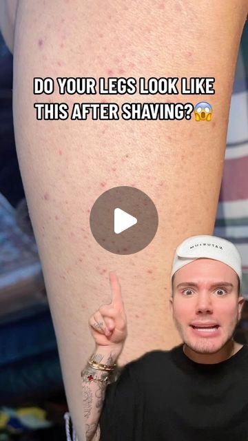 Matt Randon 🧩 on Instagram: "HOW TO GET RID OF BUMPS ON LEGS!😱 (follow for more!💗)

#skincarecommunity #skincarejunkie #skincareaddict #skincarelover #pimple #pimples #shaving #waxing #acnetreatment" Leg Pimples, Bumps On Legs, Matt Randon, Beautiful Inside And Out, After Shave, Follow For More, Shaving, Skin Care, On Instagram