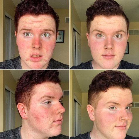 This clear skin transformation from @jakeyoncetv has us over the 🌙!! Send us your progress pics for a chance to be featured and even get half off your next payment 💸 #BioClarityClear Skin Transformation, Clear Glowing Skin, Vegan Skincare, Progress Pictures, Natural Plant, Clear Skin, Glowing Skin, Paraben Free Products, Cruelty Free