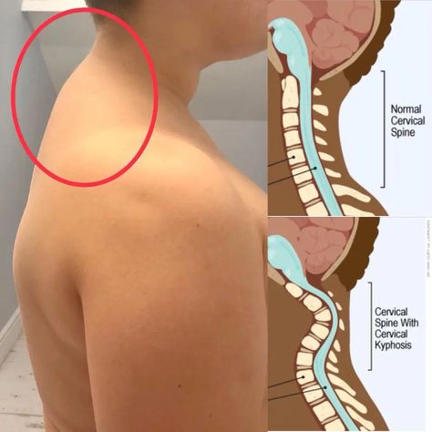 A Guide To Know About Cervical Kyphosis | Spine Surgeon Tens Unit Placement, Jaw Pain Relief, Spine Problems, Spine Pain, Lumbar Spine, Jaw Pain, Types Of Surgery, Severe Headache, Ten Unit