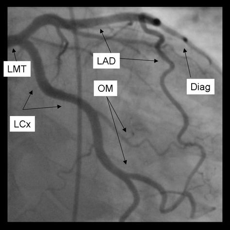 Normal Coronary Angiogram | Left Coronary Artery Cardiac Cath Lab Nurse, Coronary Angiography, Cath Lab Nursing, Cath Lab Nurse, Nerdy Nurse, Interventional Cardiology, Computed Tomography, Coronary Artery, Interventional Radiology