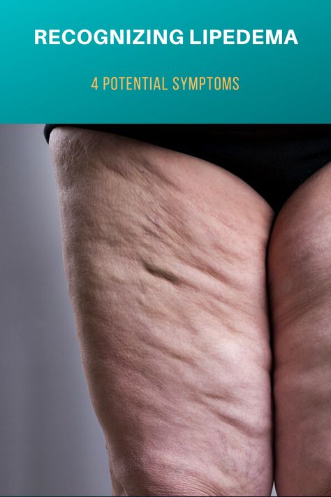 Lipedema Legs, Home Remedies For Spiders, Lymph Drainage Massage, Eating Quotes, Lymph Massage, Lymph System, Lymph Drainage, Swollen Legs, Health Info