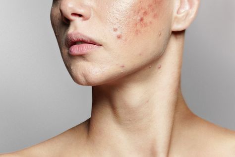 Lichen Planus, Acne Medicine, Pimples Under The Skin, Acne Skincare Routine, Types Of Acne, Hormonal Acne, Clear Complexion, Cystic Acne, Skin Pores