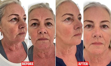 Woman, 60, reveals incredible transformation after undergoing non-surgical facelift | Daily Mail Online Facelift Before And After, Face Transformation, Non Surgical Facelift, Crepey Skin, Heavy Makeup, Skin Structure, Saggy Skin, Hair Solutions, Skin Rejuvenation