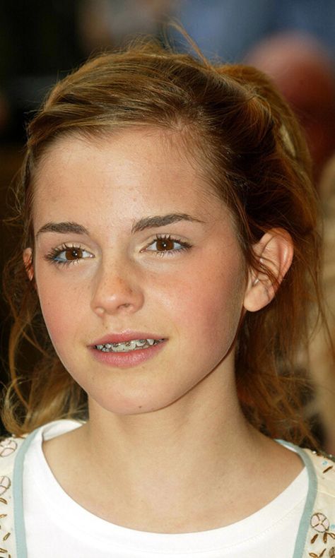 The best throwback photos of Emma Watson as she turns 30 - Photo 12 Celebrities With Braces, People With Braces, Invisible Teeth Braces, White Braces, Girls With Braces, Braces Girls, Cute Braces, Brace Face, Braces Colors