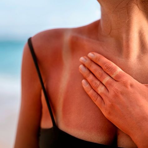 How to Soothe and Heal a Sunburn Quickly — Health Sunburn Aesthetic Face, Heal Sunburn, Sunburn Skin, Defense Mechanism, Post Inflammatory Hyperpigmentation, Prevent Ingrown Hairs, Exfoliating Scrub, Lip Hydration, Ultraviolet Rays