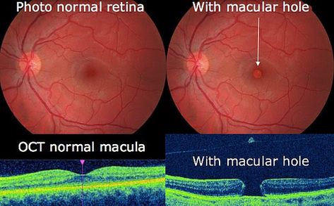 Macular Hole, Vitrectomy Surgery, Eye Retina, Strep Throat, Lip Care Routine, Windy City, Success Rate, The Vision, Eye Health