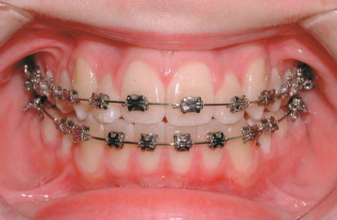 Diy Braces, Best Whitening Toothpaste, Peroxide Teeth Whitening, Types Of Braces, Teeth Alignment, Brace Face, Teeth Braces, Greater Noida, Dental Services