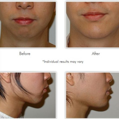 Dr. Kwan can improve the lines of your jaw using chin implants and shaping or a jaw reduction for a slimmer, V-shaped appearance.

Learn more at 
http://www.facialshaping.com/ 

#chinimplant #plasticsurgery #facialshaping V Shaped Jaw, Chin Implant, Facial Anatomy, Plastic Surgery, V Shape, Anatomy, Facial