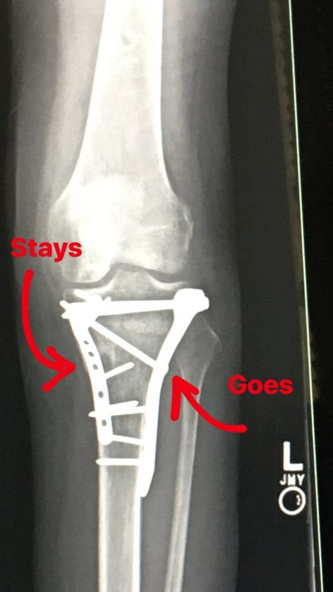 So on Tuesday, I'm sitting at my orthopedic surgeon 11 month follow up appointment nervous as all hell. Tibial Plateau Fracture, Orthopedic Surgeon, Shin Splints, Secure Attachment, Walking Exercise, After Surgery, The Kitchen, How To Memorize Things