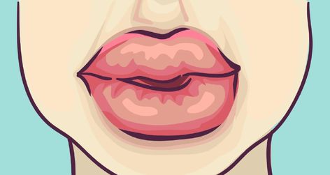 Swollen Lips (Allergy): Symptoms, Causes, Treatments & Home Remedies Swollen Lip Remedy, Lip Infection, Lip Allergy, Swollen Lips, Itchy Ears, Swollen Tongue, Itchy Eyes, Cracked Lips, Bottom Lip