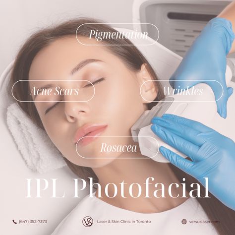 IPL (Intense Pulsed Light) photofacial addresses various skin concerns: ☀️ Sun Damage: Fades sunspots and age spots. 🌹 Rosacea: Reduces redness and visible blood vessels. 🌟 Uneven Skin Tone: Evens out complexion. 🧖‍♂️ Fine Lines: Improves skin texture. 🌼 Acne Scars: Minimizes redness and pigmentation. 💚 VS MedSpa Laser & Skin Clinic in Toronto:⁣ #SkinRejuvenation #IPLPhotofacial #iplphotofacialrejuvenation #vsmedspa #ipl #torontomoms #toronto #torontolife #antiagingtreatment #esthetician Ipl Photofacial, Body Laser, Skin Laser, Laser Clinic, Pregnancy Skincare, Intense Pulsed Light, Laser Clinics, Ipl Laser, Laser Skin